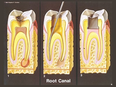 Endodoncija